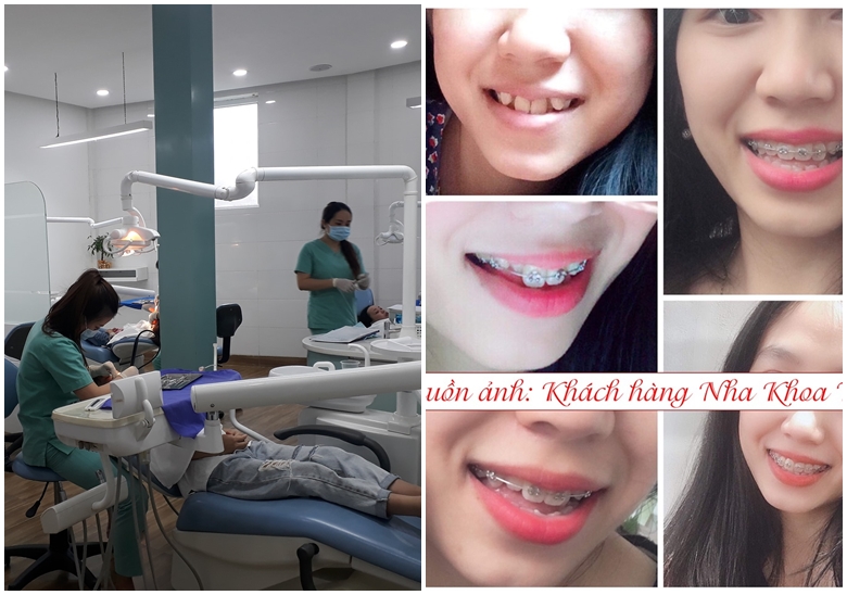 top 10 dia chi nieng rang o hue uy tin chat luong nhat hien nay 5862