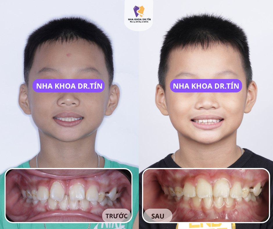 Nha khoa Dr.Tín: Niềng răng trọn gói, hợp đồng rõ ràng