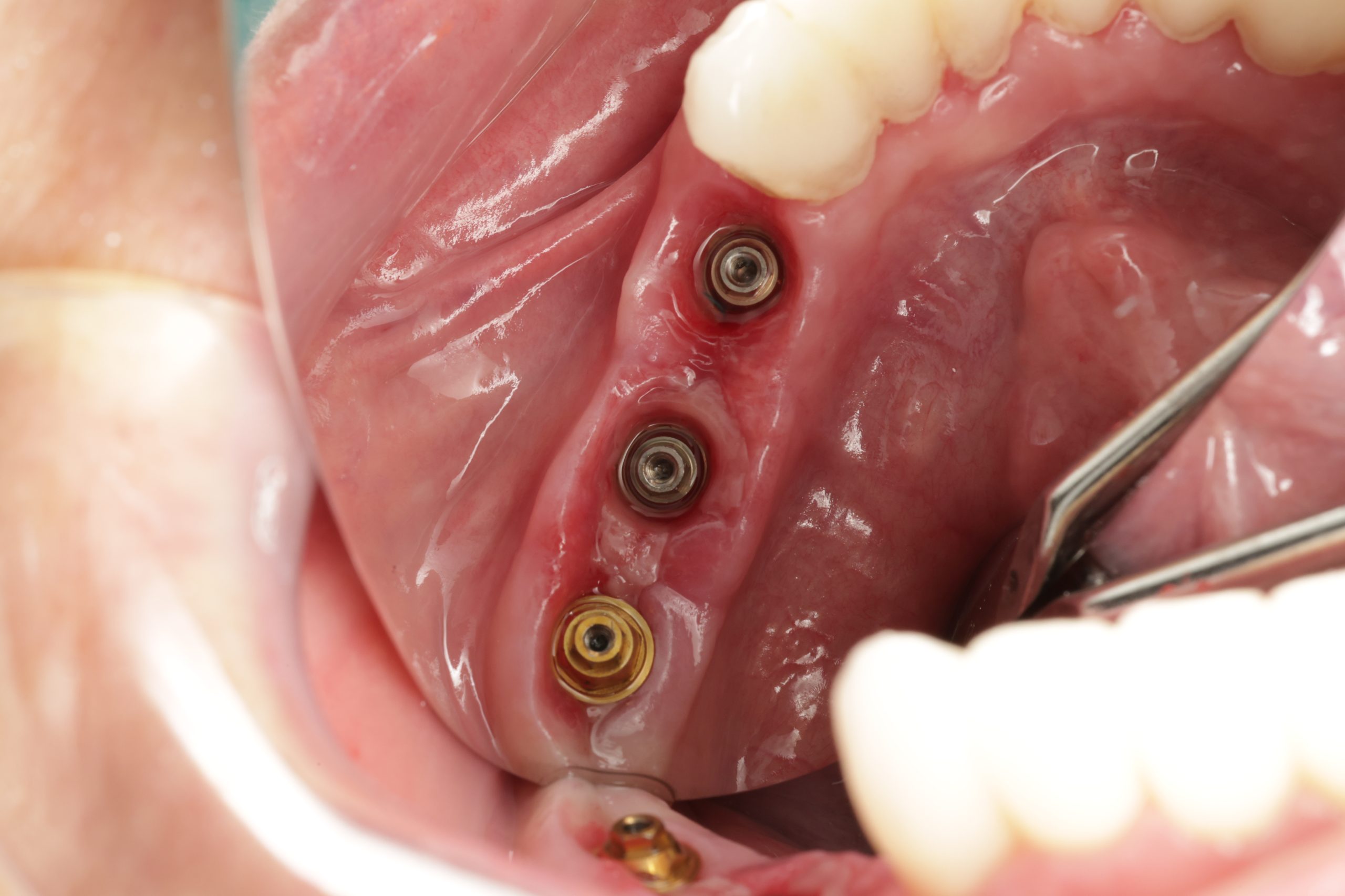 Cấy ghép Implant tại Huế: Phục hồi răng mất, khôi phục khả năng ăn nhai