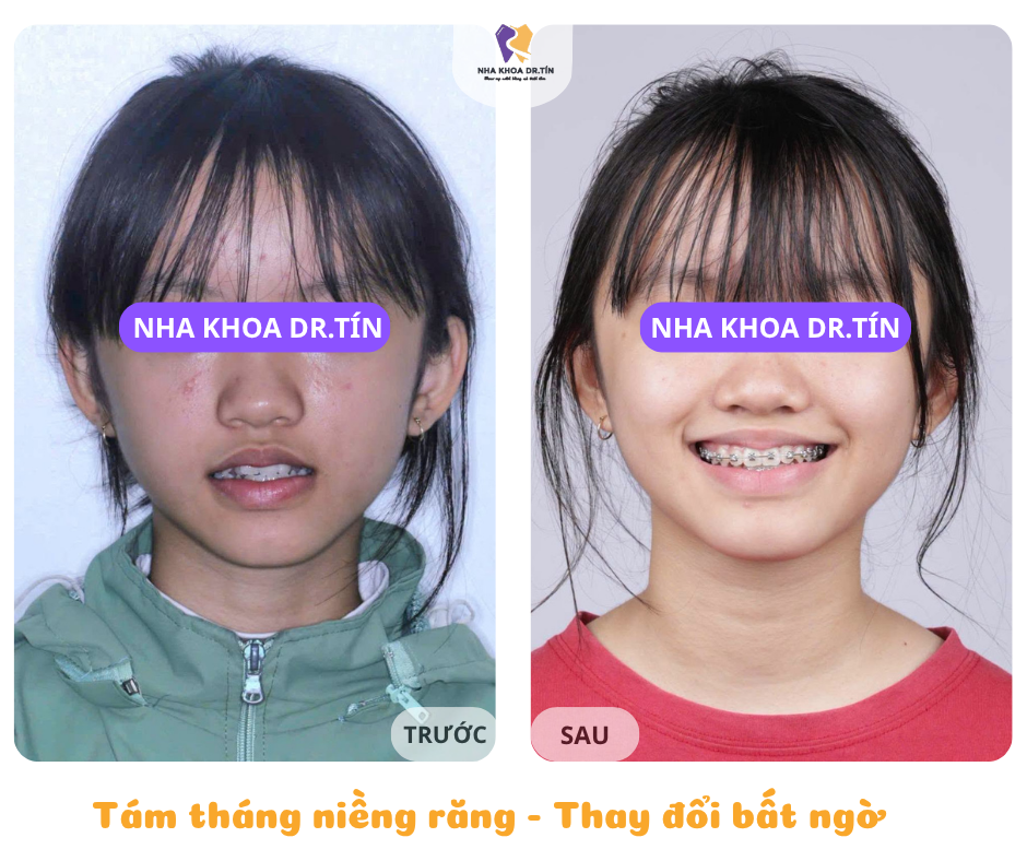 Nha khoa Dr.Tín: Niềng răng trọn gói, hợp đồng rõ ràng