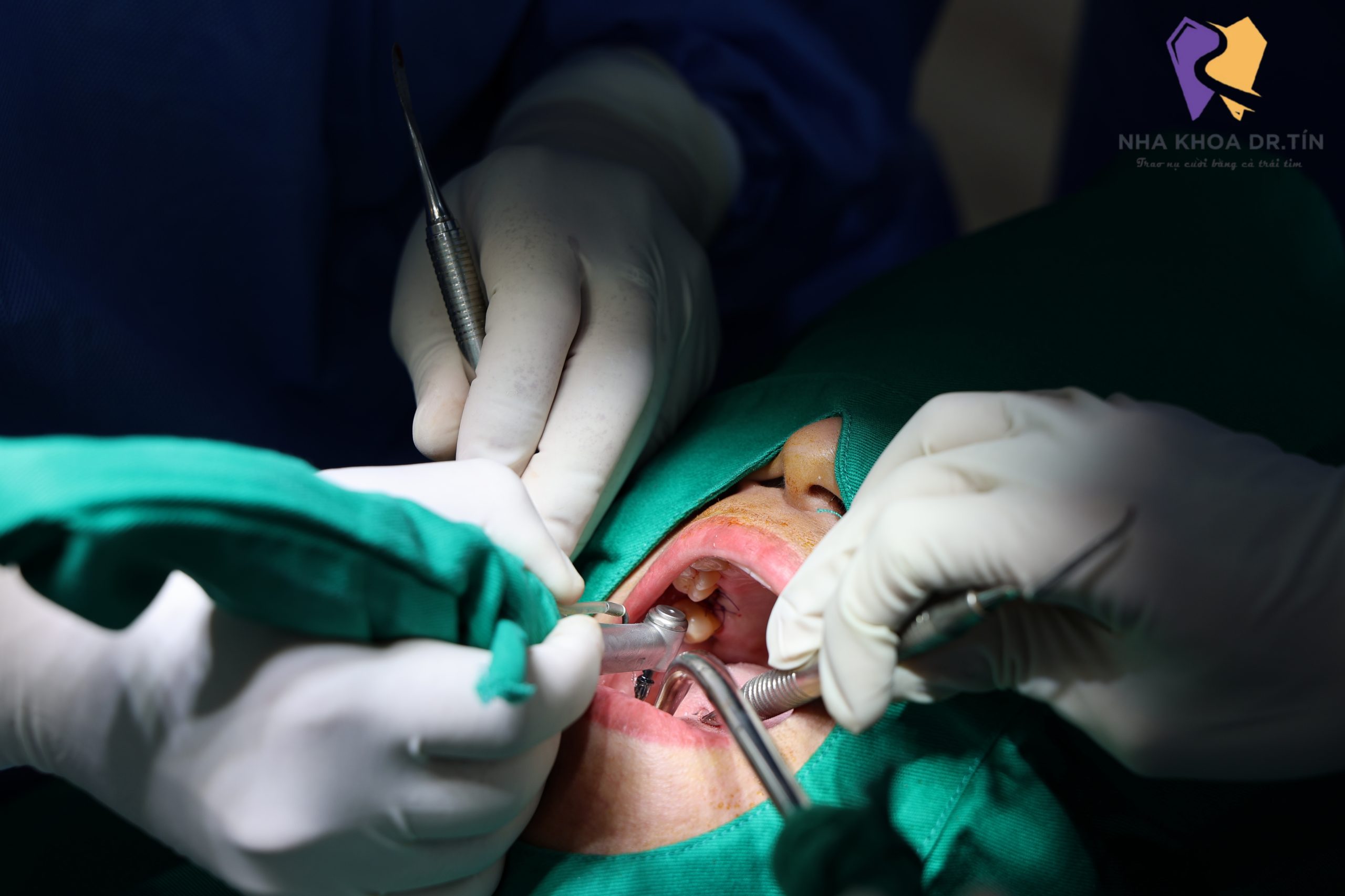 Cấy ghép Implant tại Huế: Phục hồi răng mất, khôi phục khả năng ăn nhai